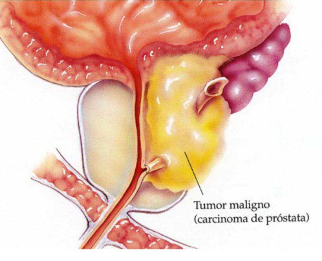 Cancer de prostata maligno, Cancer de prostata benigno y maligno